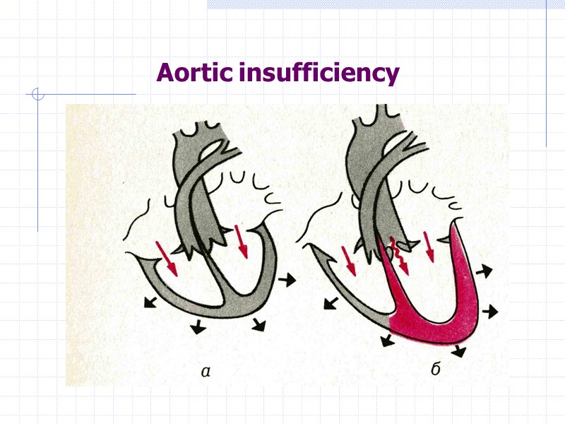 Aortic insufficiency